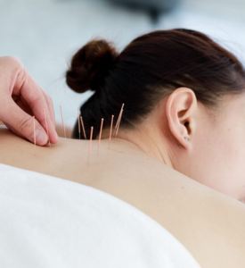 Acupuncture in Highgate, North London